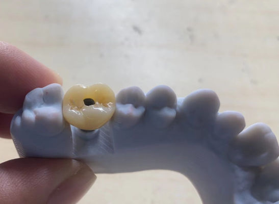Buy High Precision Implant Supported Crown Stable And Easy Maintenance online manufacture