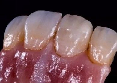 Buy German Amanjilbach Zirconia Dental Crown High Density With Customization online manufacture