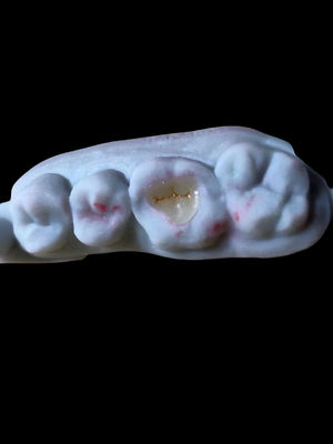 Buy Natural Translucent All Ceramic Dental Emax Onlay For Dental Restoration online manufacture
