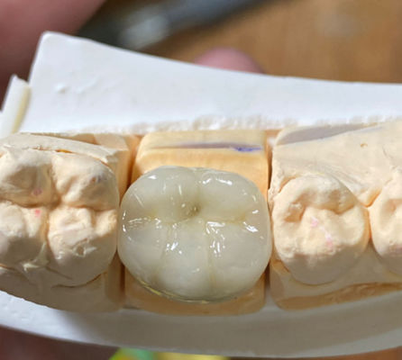 Buy Precise Esthetic Strong Dental PFM Porcelain Fused To Metal Crown In Dentistry online manufacture