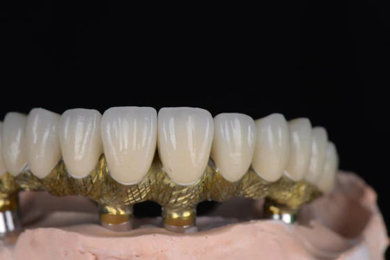 Buy Natural Looking Crown Porcelain Fused To Metal High Precision For Dental Implants online manufacture