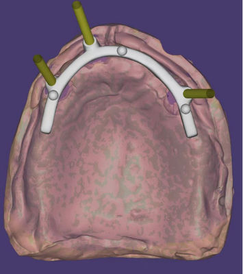 Buy Customized Dental CAD CAM Design High Precision For Implant Supported Bar online manufacture