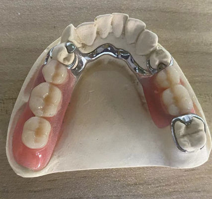 Buy Reliable Silver Metal Frame Denture Corrosion Resistance With Customizable Design online manufacture