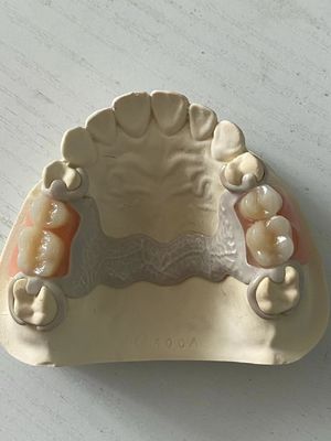Buy Customized Dental PEEK Acrylic Partial Denture Adjustable With Secure Fit online manufacture