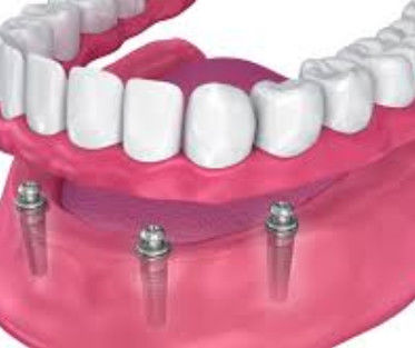 Buy Customizable Implant Ball Attachment Long Lasting For Implant Retained online manufacture