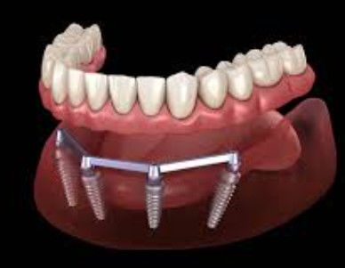 Buy Sandblasted Denture Implant Bar For Translucent And Natural Esthetics online manufacture