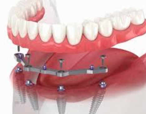 Buy Full Arch Milled Titanium Bar Dental 12mm Length With 2+ Attachments online manufacture