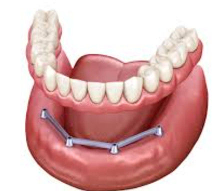 Buy Screw Retained Translucency Implant Bar Denture Polished Surface Implant Bar online manufacture