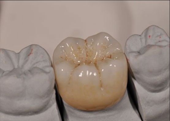 High Aesthetic Noritake Zirconia Natural Color Stable For Full Zirconia Crown