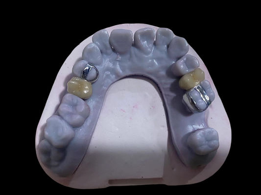 Highly Precise PFM Crown Dental Alloy Ni Free Metal Porcelain Crowns