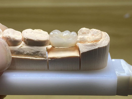 Stain Resistance PFM Ceramic Crown Adjustable With Natural Tooth Shape