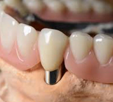 Customizable Dental Telescopic Crown High Precision With Natural Looking