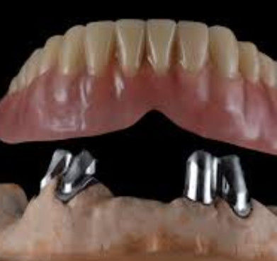 Comfortable Easy Maintenance Telescopic Crowns Customized For Dental Restoration