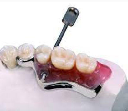 Easy Installation Key And Keyway Dental Attachment Oxidation Resistant